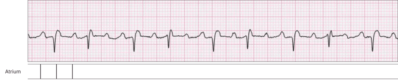 Three atrial impulses dropped on clearly visible flutter waves in a V1 rhythm strip.