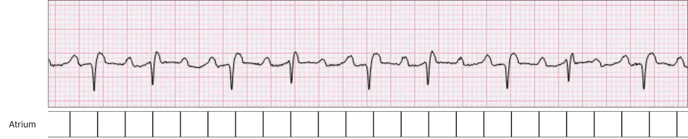 The impulses repeated across the strip and spaced evenly, including flutter waves hidden in QRS complexes and T waves.